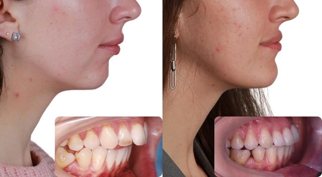 Braces for overbite | Achieving a Balanced Bite: A Comprehensive Guide to Braces for Overbite