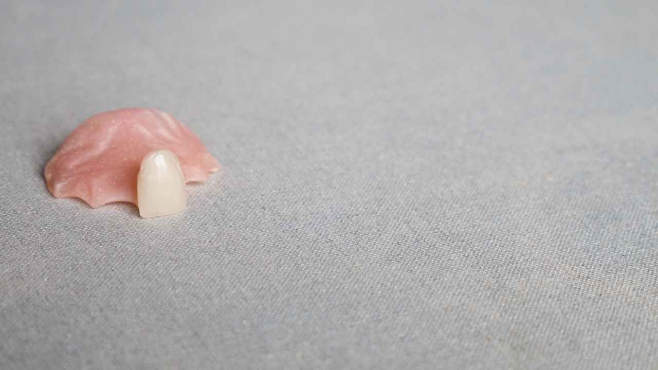 Partial Denture for One Tooth