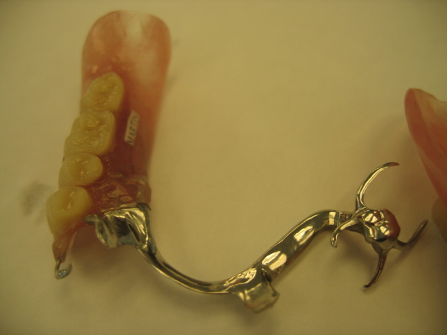 partial dentures for back teeth on one side