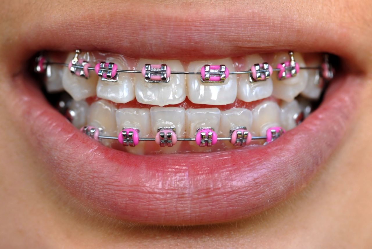 picture of girl having Pink Braces.