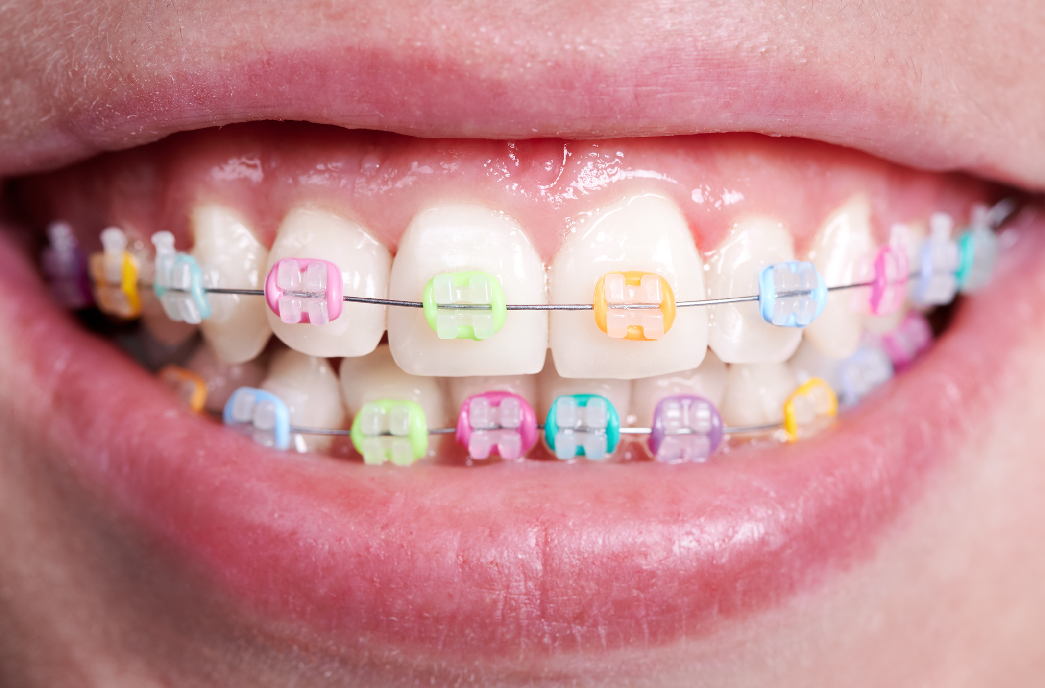 picture of girl having Pink Braces.