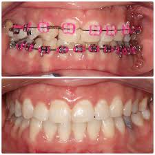 pink braces in Picture