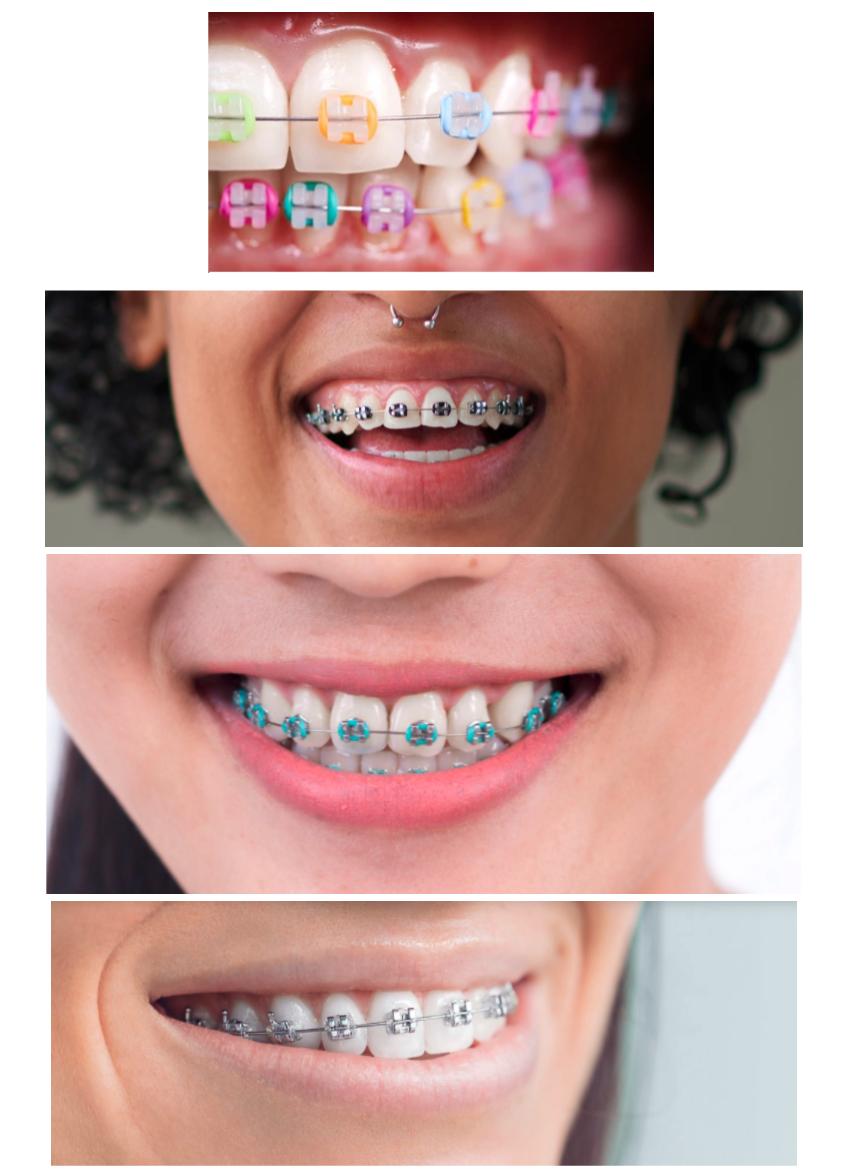 recommended braces color