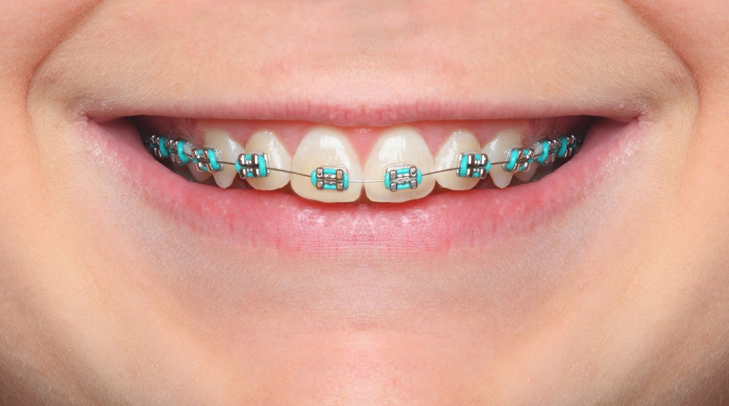 recommended braces color-best-braces-colors-selecting-the-right-braces-colour