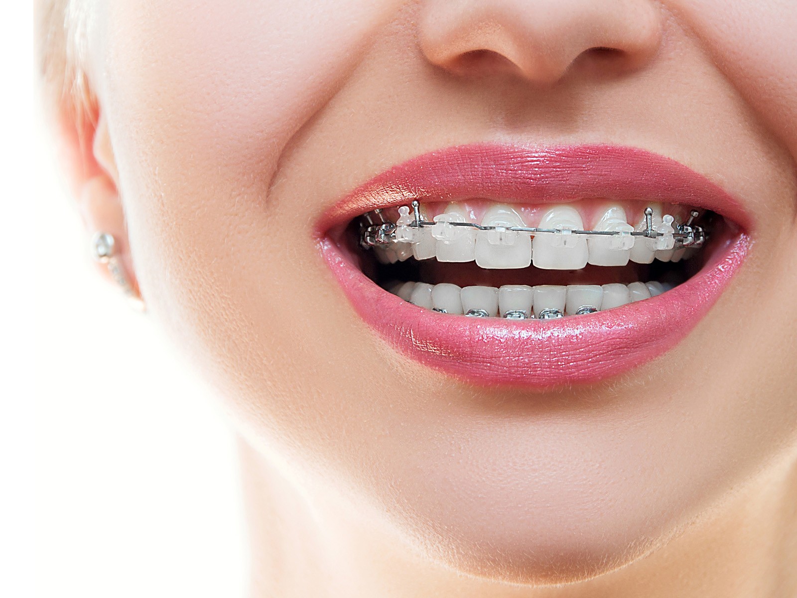 recommended braces color-best-braces-colors-selecting-the-right-braces-colour