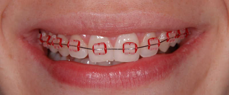 girl with red braces on teeth.