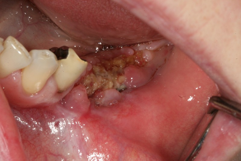 signs of dental bone graft failure