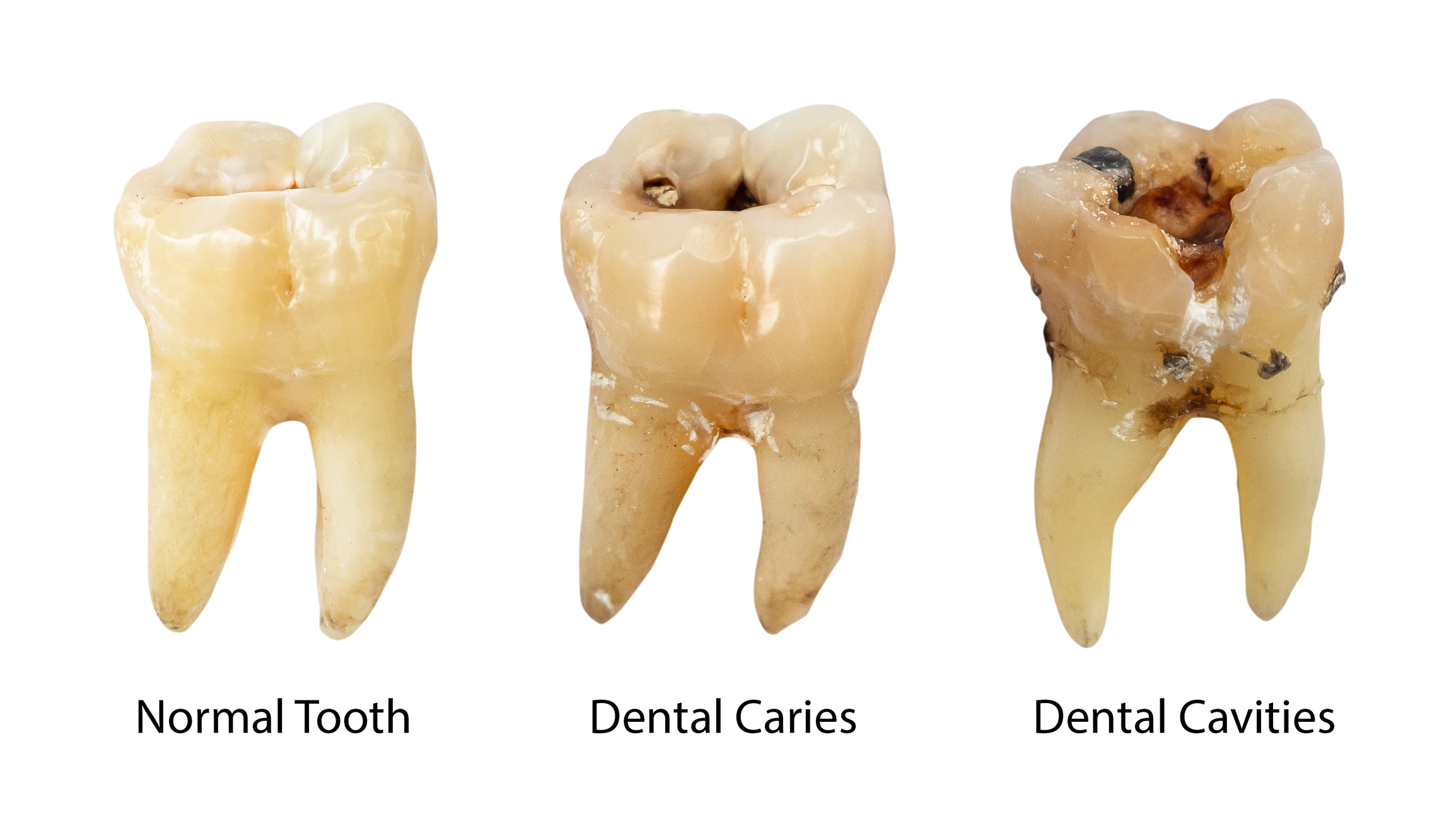 stages of tooth decay