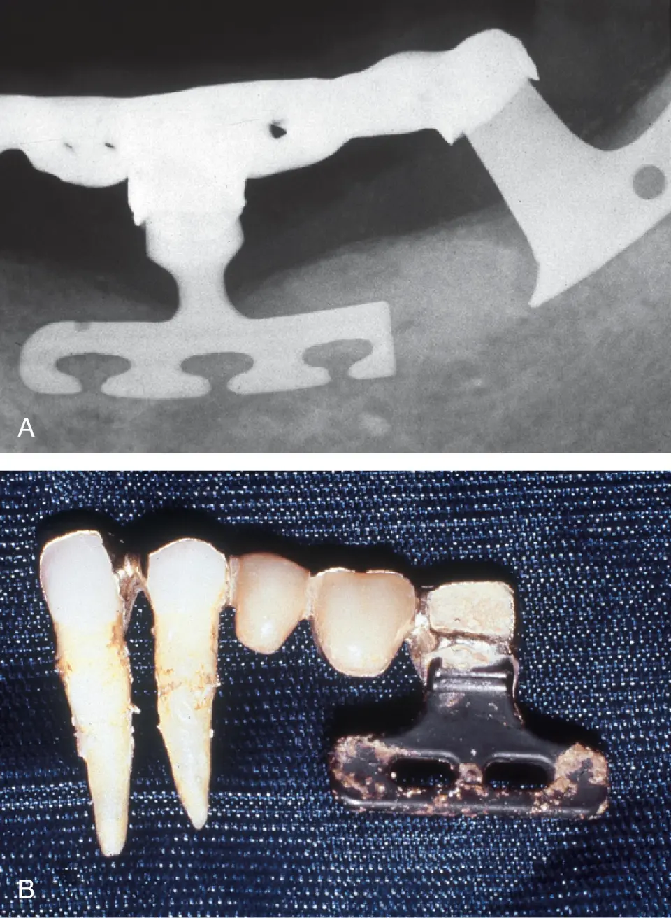 subperiosteal-dental-implants