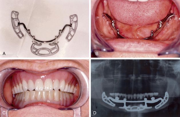 subperiosteal-dental-implants image