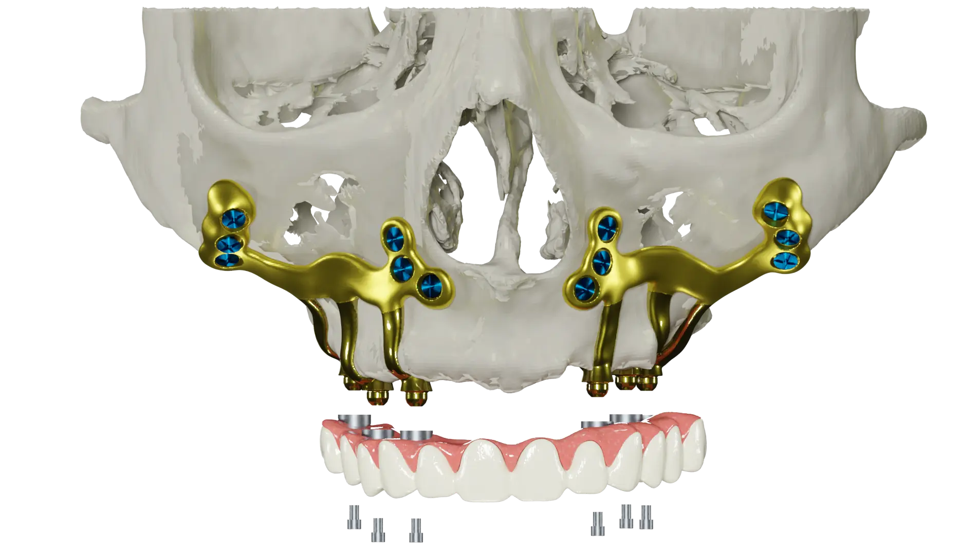 subperiosteal-dental-implants for upper jaw