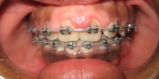 image of swollen gums with braces.