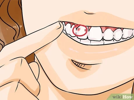 how to-know-if-you-have-teeth-decay