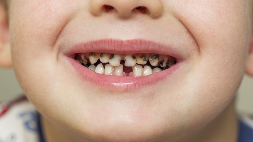 Symptoms of Tooth Decay in Children