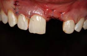 What Happens If I Don’t Get a Bone Graft After Tooth Extraction?