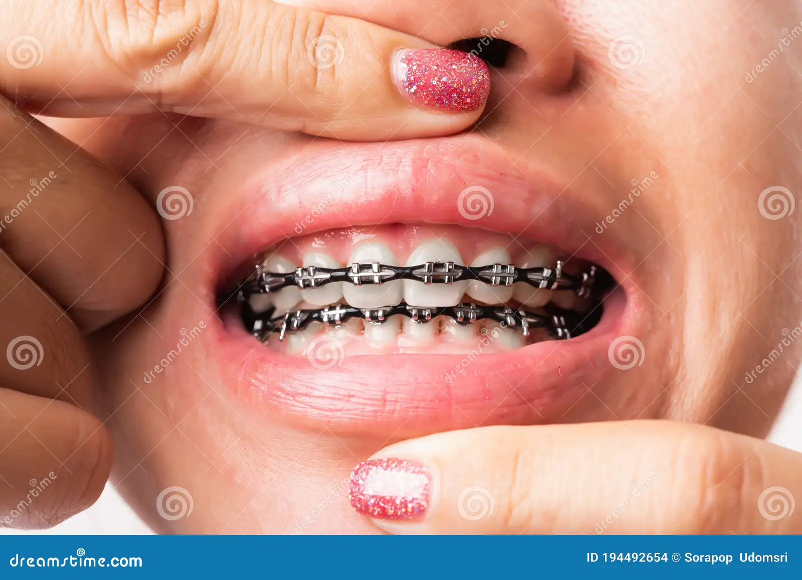 Black Braces: A Comprehensive Guide to Modern Orthodontic Treatment