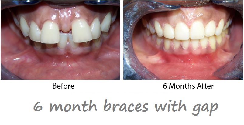 6 month braces with gap