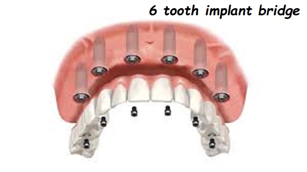 6 tooth implant bridge