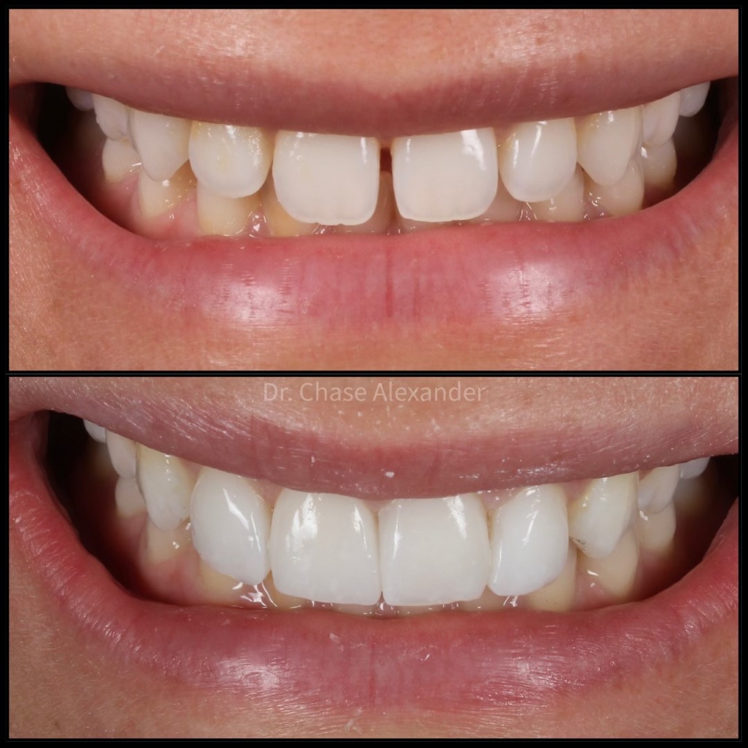 composite veneers