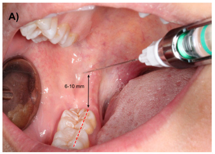 inferior alveolar nerve block