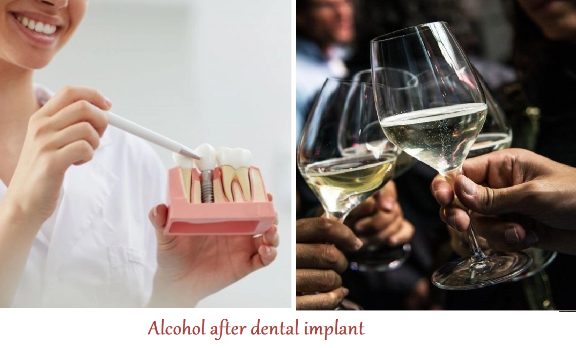 Alcohol after dental implant