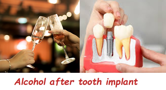 Alcohol after tooth implant