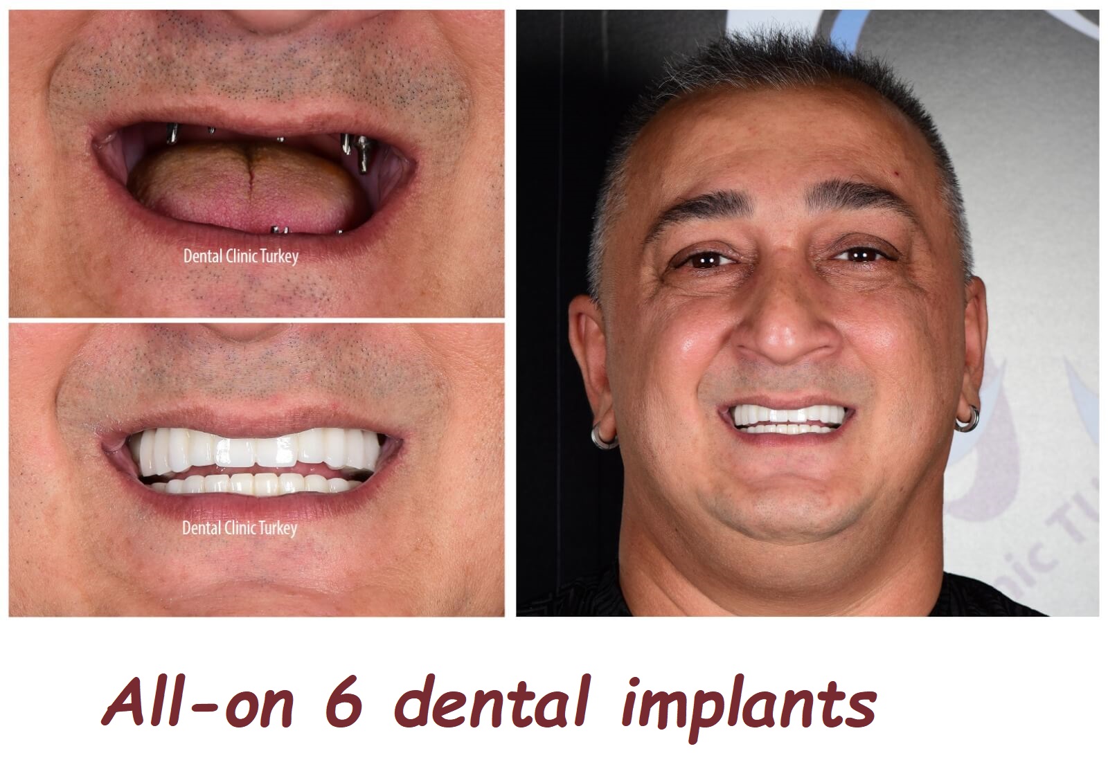 All-on 6 dental implants