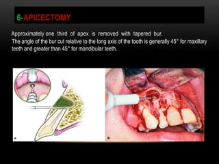 apicoectomy recovery
