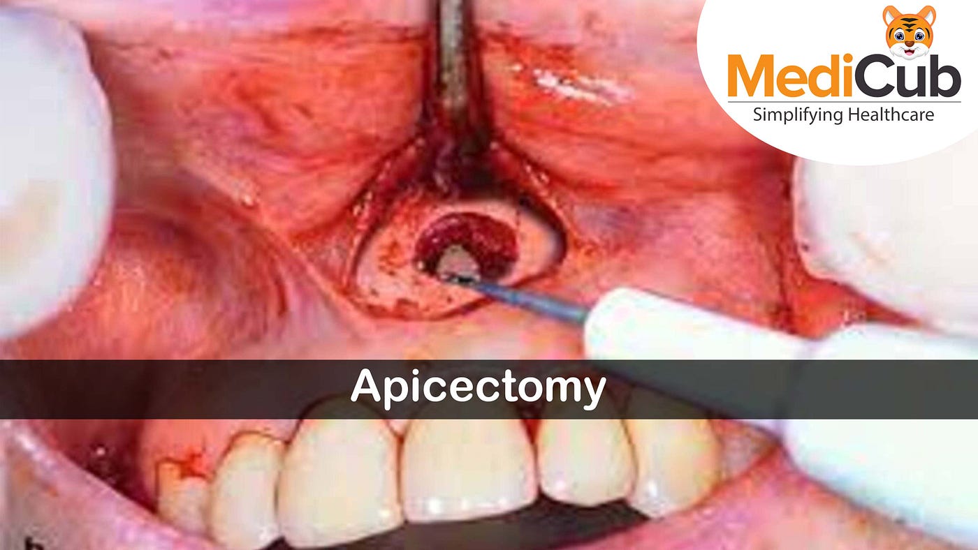 Apicectomy of Tooth