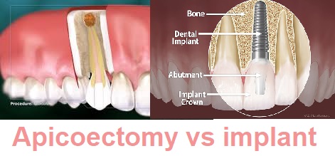 apicoectomy vs implant