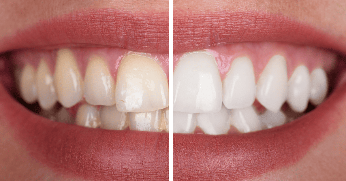 best teeth whitening