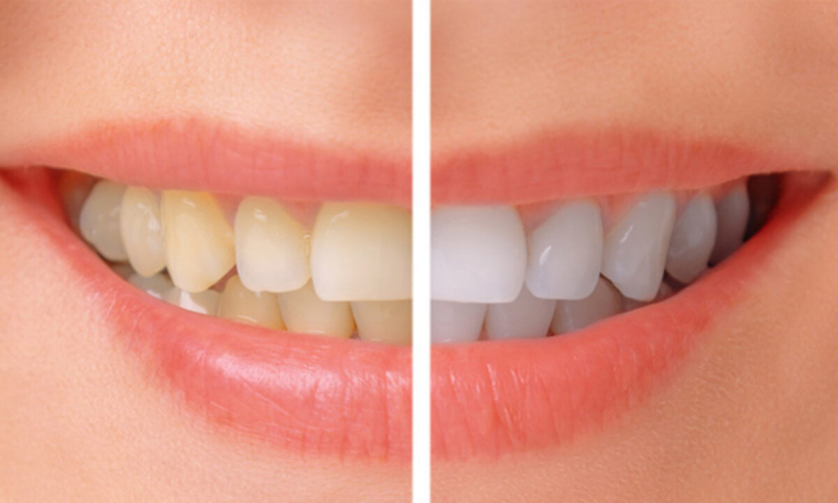 best teeth whitening