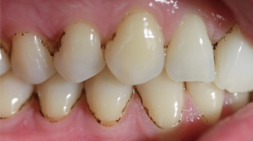 black spots on teeth that aren’t cavities