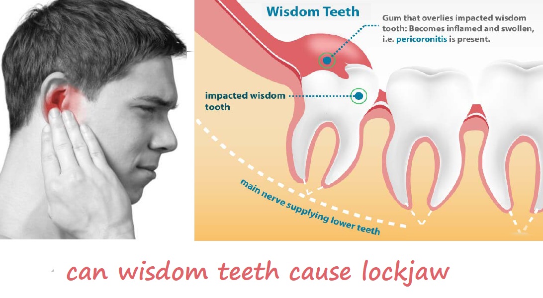 can wisdom teeth cause lockjaw