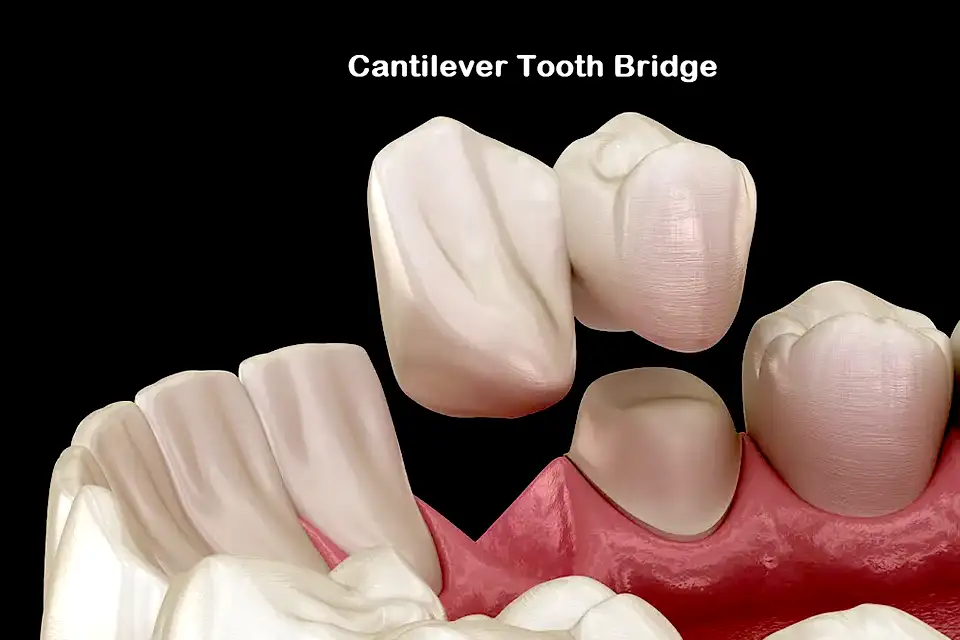 What is a Cantilever Bridge Dental