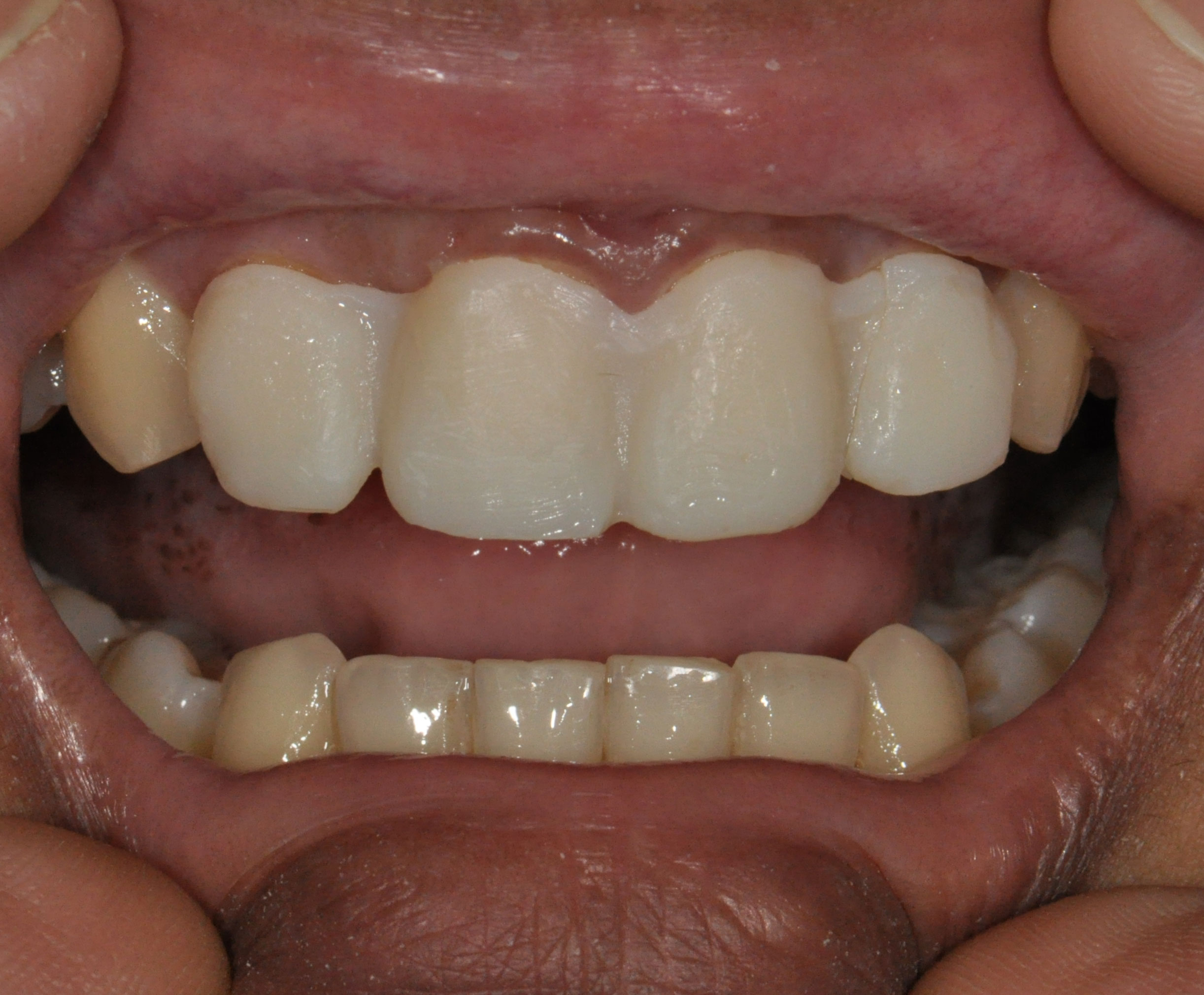 Composite Resin Crowns for front teeth