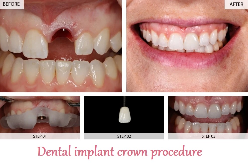 Dental implant crown procedure