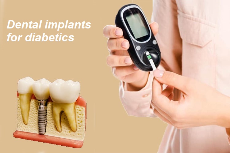 Dental implants for diabetics