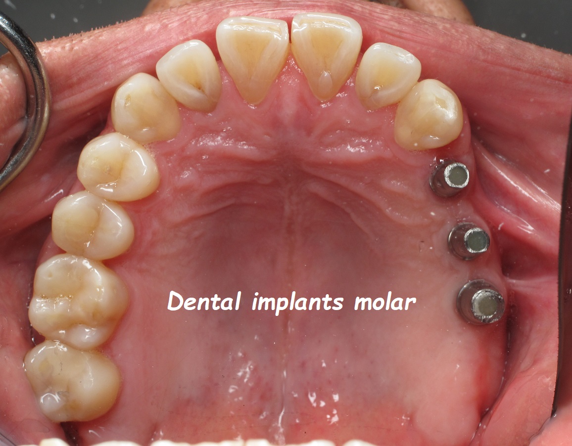 Dental implants molar