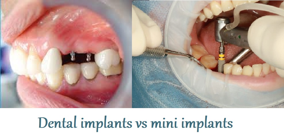 Dental implants vs mini implants