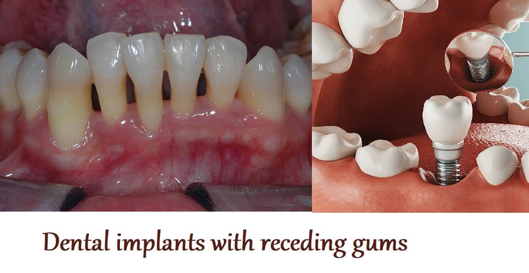 Dental implants with receding gums