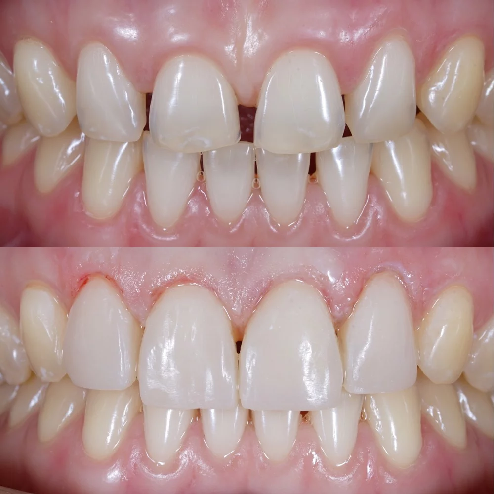 composite veneers