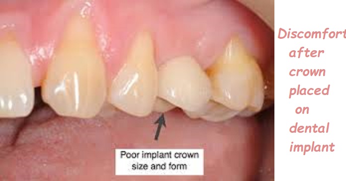 Discomfort after crown placed on dental implant