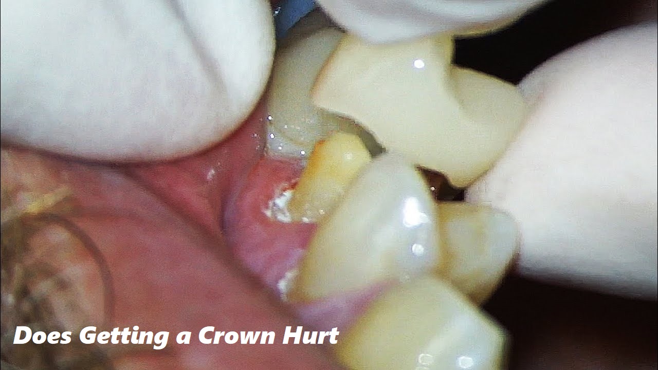 Does Getting a Crown Hurt