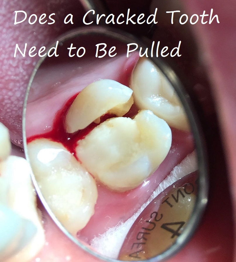 Does a Cracked Tooth Need to Be Pulled