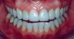 healthy gums color