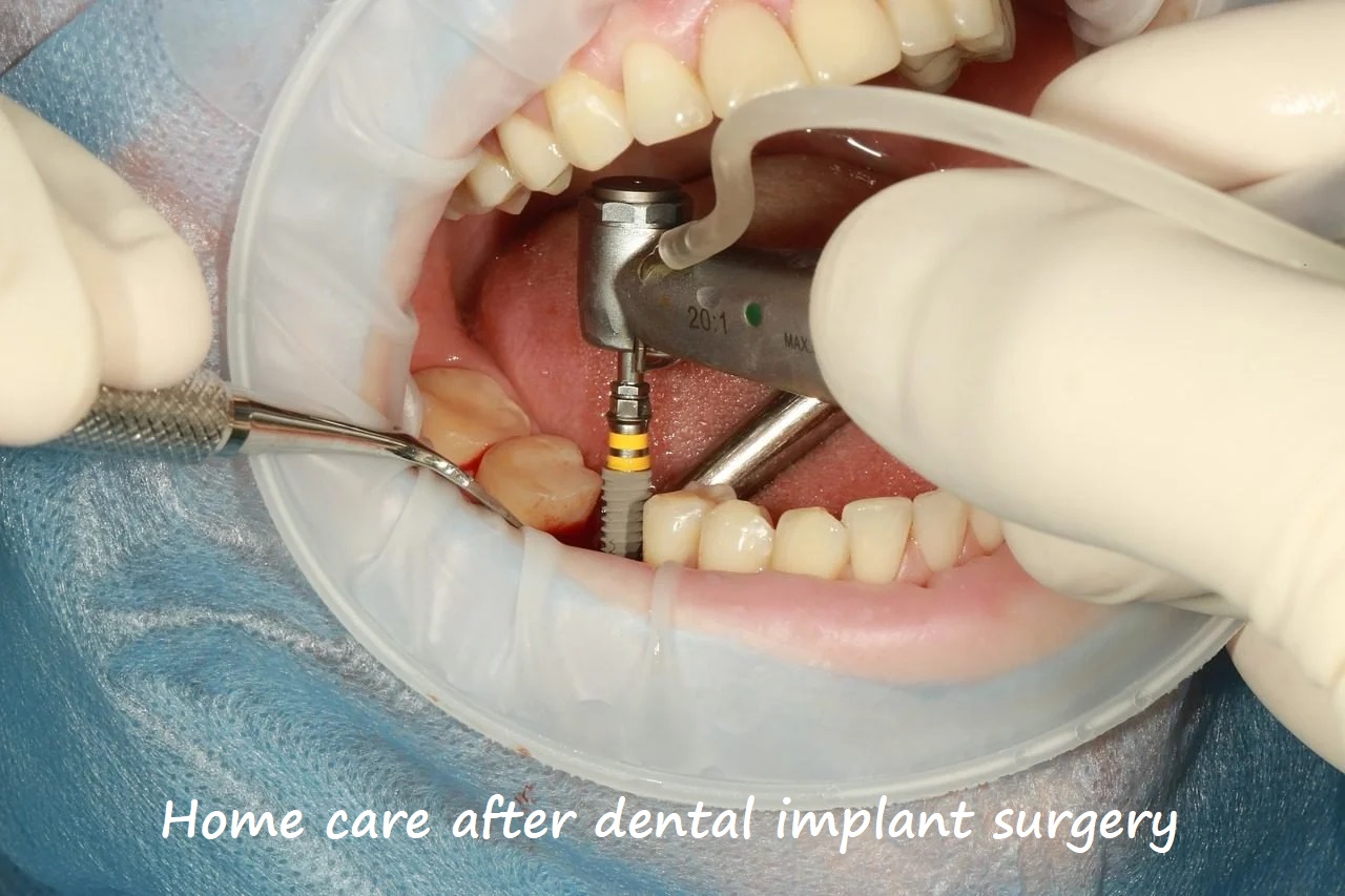 Home care after dental implant surgery