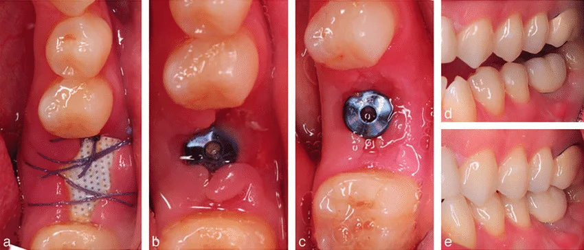 How Long Does a Tooth Implant Take to Heal