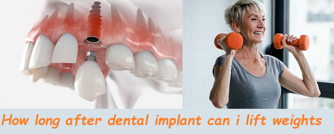 How long after dental implant can i lift weights