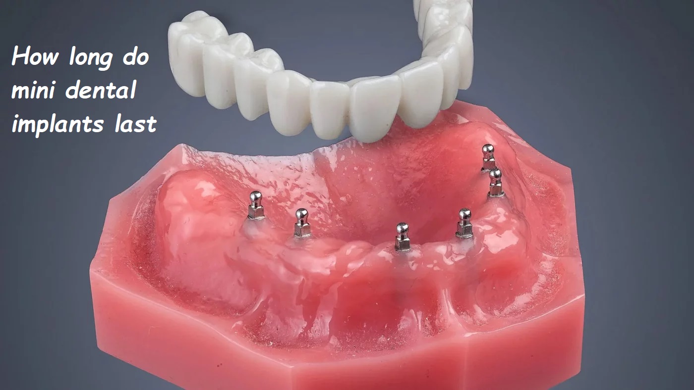 How long do mini dental implants last